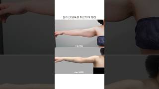 60kg 감량 후 늘어진 팔뚝살 해결하는 방법 #팔거상 #팔지방흡입 #지방흡입 #지방흡입후기 #성형전후 #성형후기 #성형정보 #조희은원장 #short
