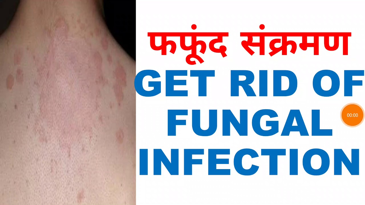फफूंद संक्रमण के घरेलू नुस्खे,HINDI,HINDI HEALTH TIPS,GET RID OF FUNGAL