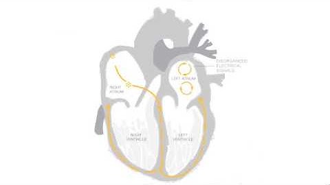 Atrial Fibrillation Screening