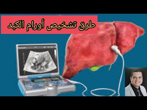 طريقة تشخيص أورام الكبد السرطانية #اورام_الكبد_السرطانية البؤر الكبدية #HCC Hepatocellular carcinoma