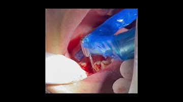 immediate implant placement with alloplastic bone graft material