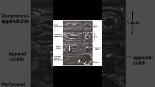 Appendix USG in 30 Sec☑️ Acute → Gangrenous → Perforated 🔥