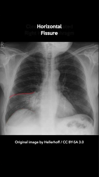 Right Middle Lobe Pneumonia Chest X-ray #shorts