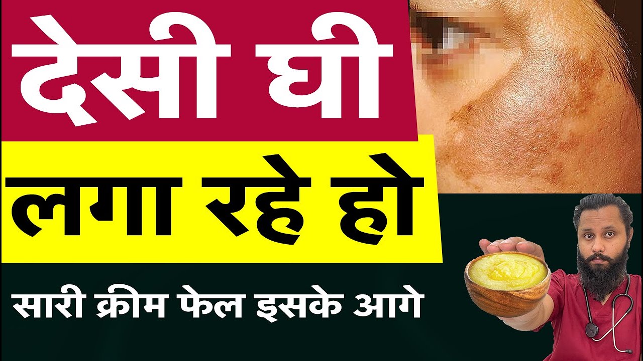 देसी घी For Pigmentation , best cream for pigmentation Dr Prateek chauhan