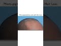 Long-Term Results of Scalp Micropigmentation ✨
