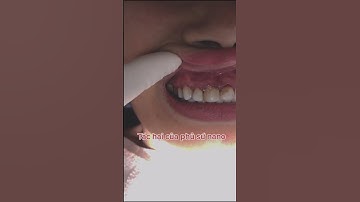 Tác hại Phủ sứ Nano - Tác hại Răng sứ Giá rẻ - Phủ sứ Nano có Hậu quả gì?