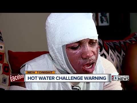 Las Vegas doctor sounds alarm about 'hot water challenge'