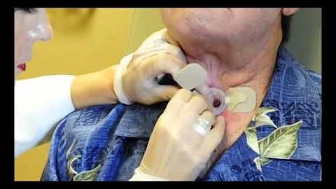 Demonstration on how to apply Provox® LaryClips™ - for clinicians