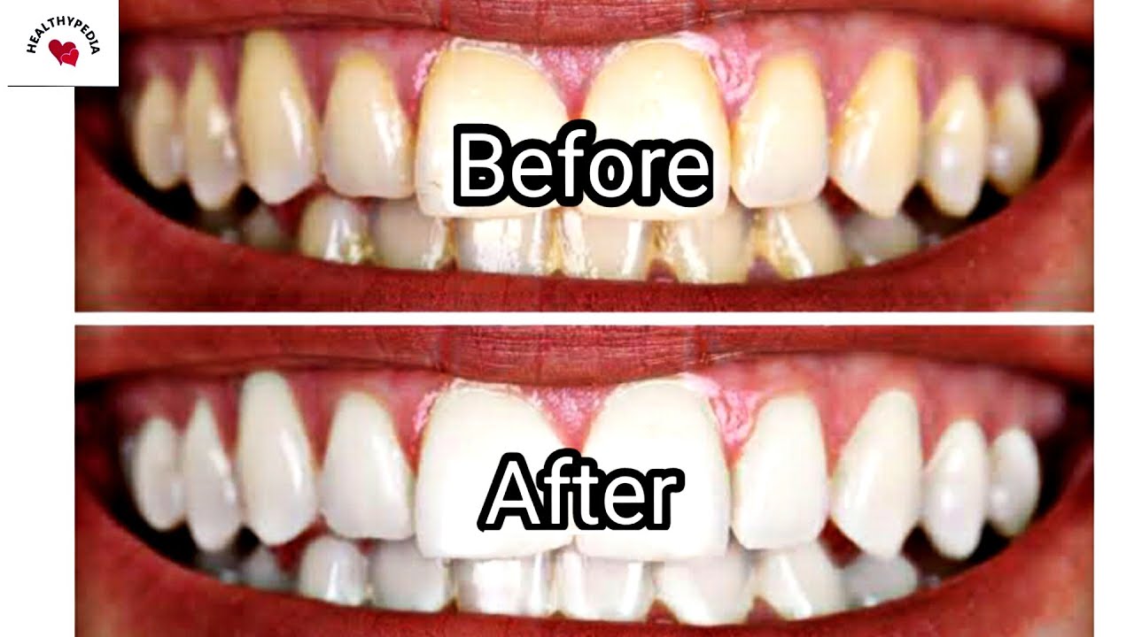 Teeth Whitening At Home 100 Effective Home Remedy Hindi YouTube