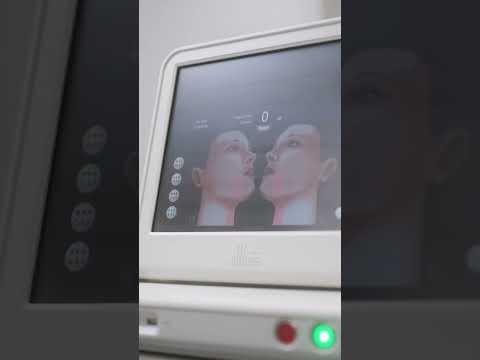 Ultherapy: un tratamiento para estimular colágeno con ultrasonido microfocalizado #colageno