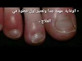 علاج تورم الاصابع أو الاصابع المتوته أو الاصبع المدوحس في الشتاء وكيفية التغلب عليه