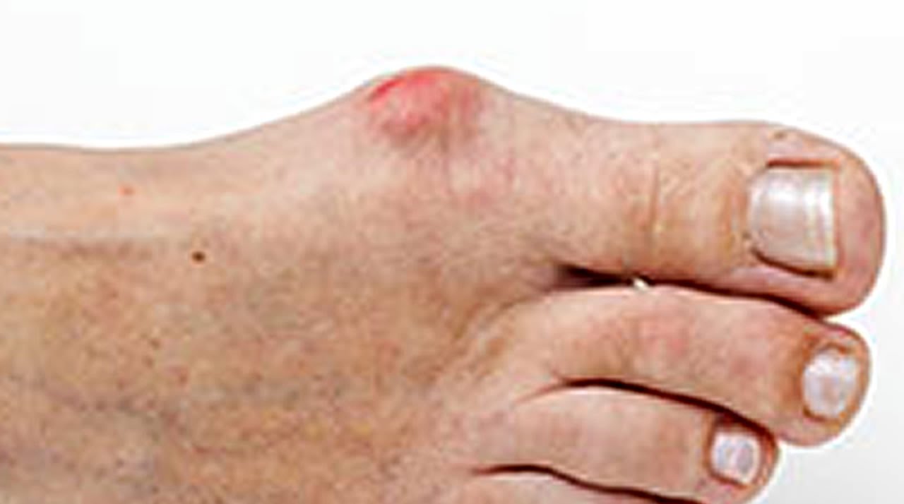 My Personal MD Are Bunions Hereditary? Podiatry YouTube