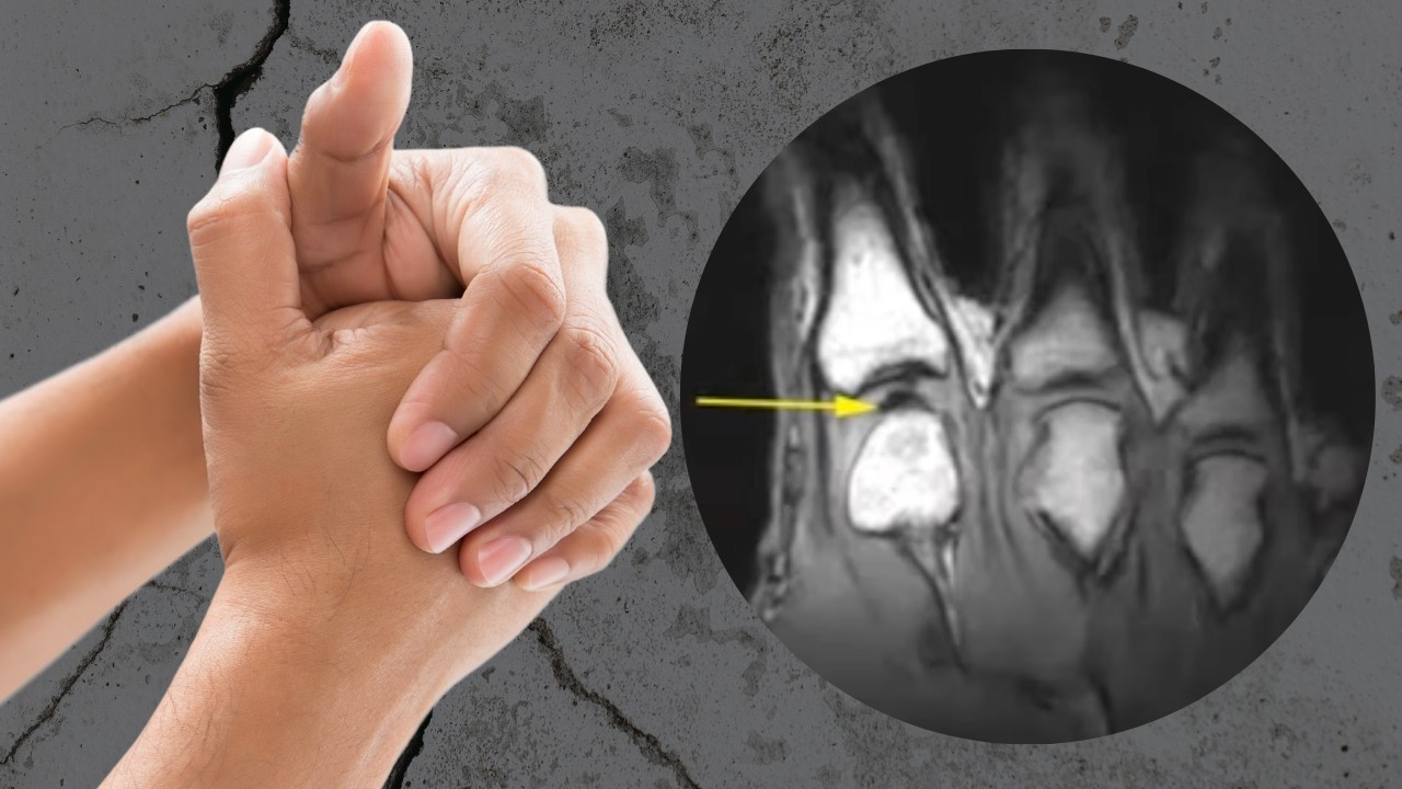 Does Joint Cracking Cause Arthritis?