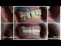 تركيب اسنان زيركون - تجميل للاسنان الامامية ..zirconium crowns for anterior teeth