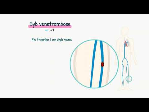 Video: Sural Venetrombose - Symptomer Og Behandling