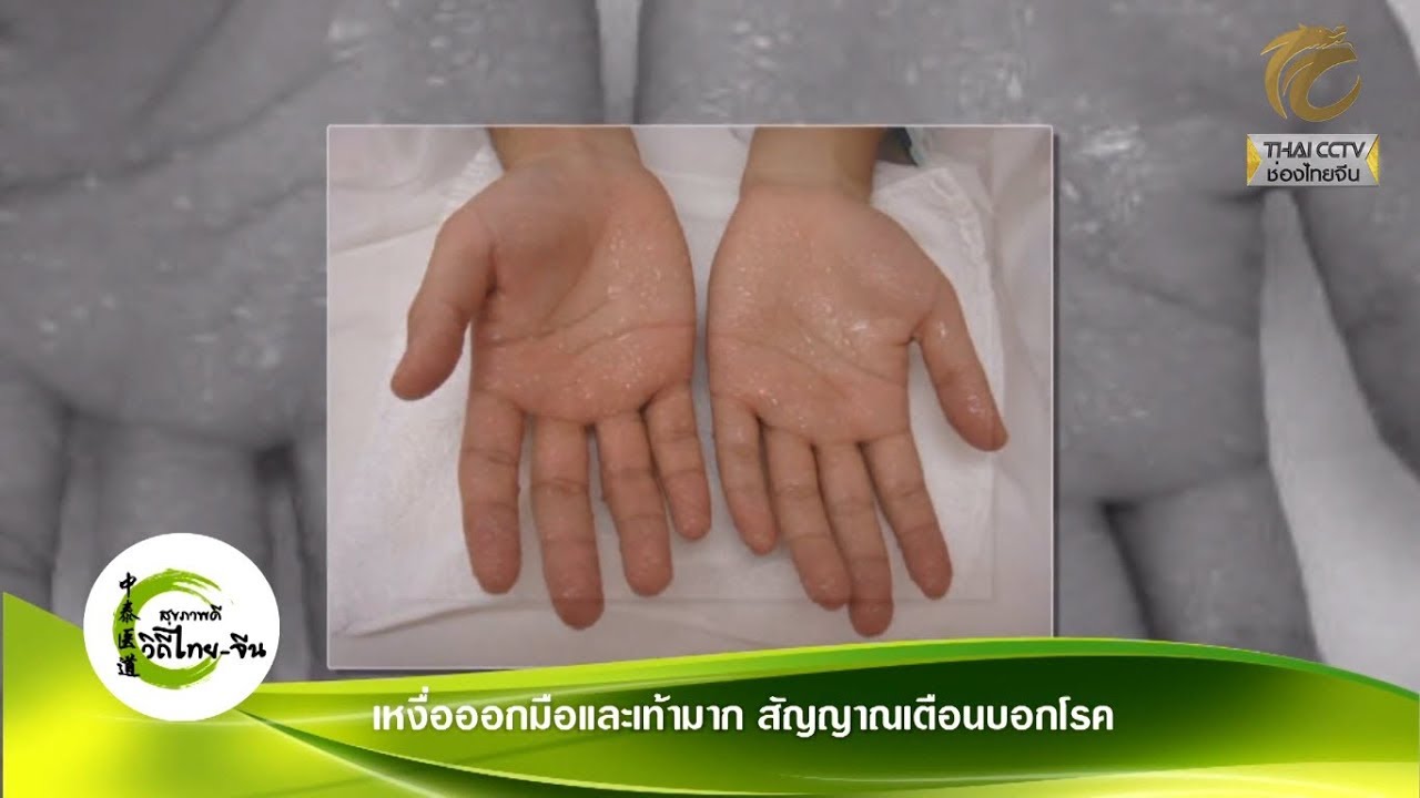 สุขภาพดีวิถีไทย-จีน EP.268 (1/3) เหงื่อออกมือและเท้ามาก สัญญาณเตือนบอกโรค โดย อ.ภานุภณ ทองประเสริฐ