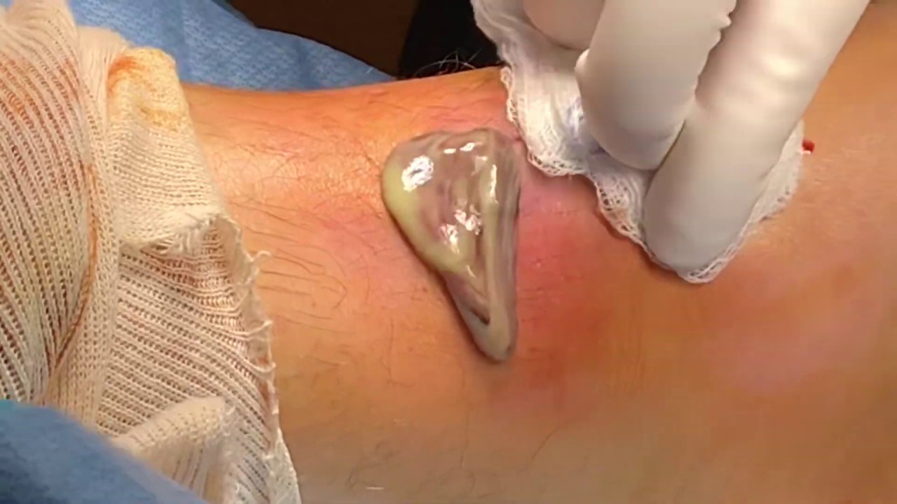 Gross moment a 25-year-old cyst is popped and oozes pus