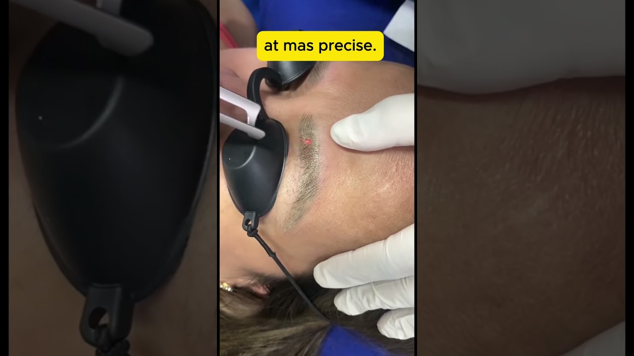 How eyebrows tattoo removal work?  