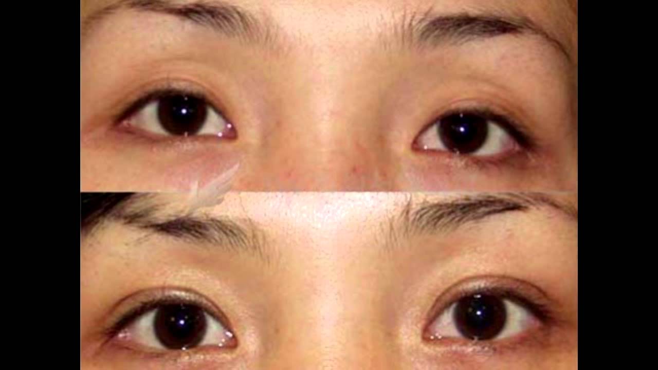 Ptosis Asian Eye 12
