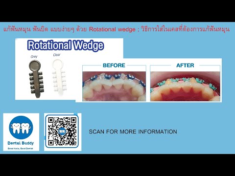 ฟันบิด ฟันหมุน ฟันซ้อนเกย์ แก้ง่ายๆ ด้วย Rotational wedge ; วิธีการใส่ Rotational wedge