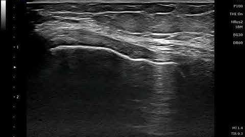 Saphenous nerve, infrapatellar branch