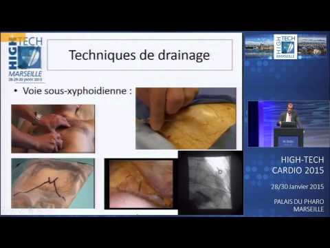 Vidéo: Inflammation Du Sac Cardiaque (péricardite) Chez Le Chat