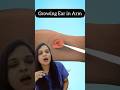 Growing ear in arm/ Dr Ramya N/#ear #newear #earhealth #surgw #eardisease #earwell #earache #earexam