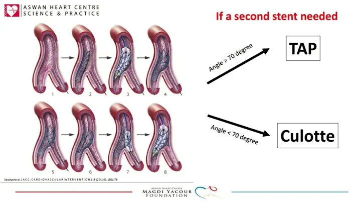 Coronary bifurcation #interventionalcardiology #bifurcation #pci