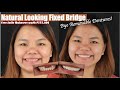 Fixed Dental Bridge to replace Removable Dentures | Apostol Dental Philippines