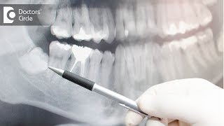 What is involved in getting a dental implant? - Dr. Sharon Colaco Dias