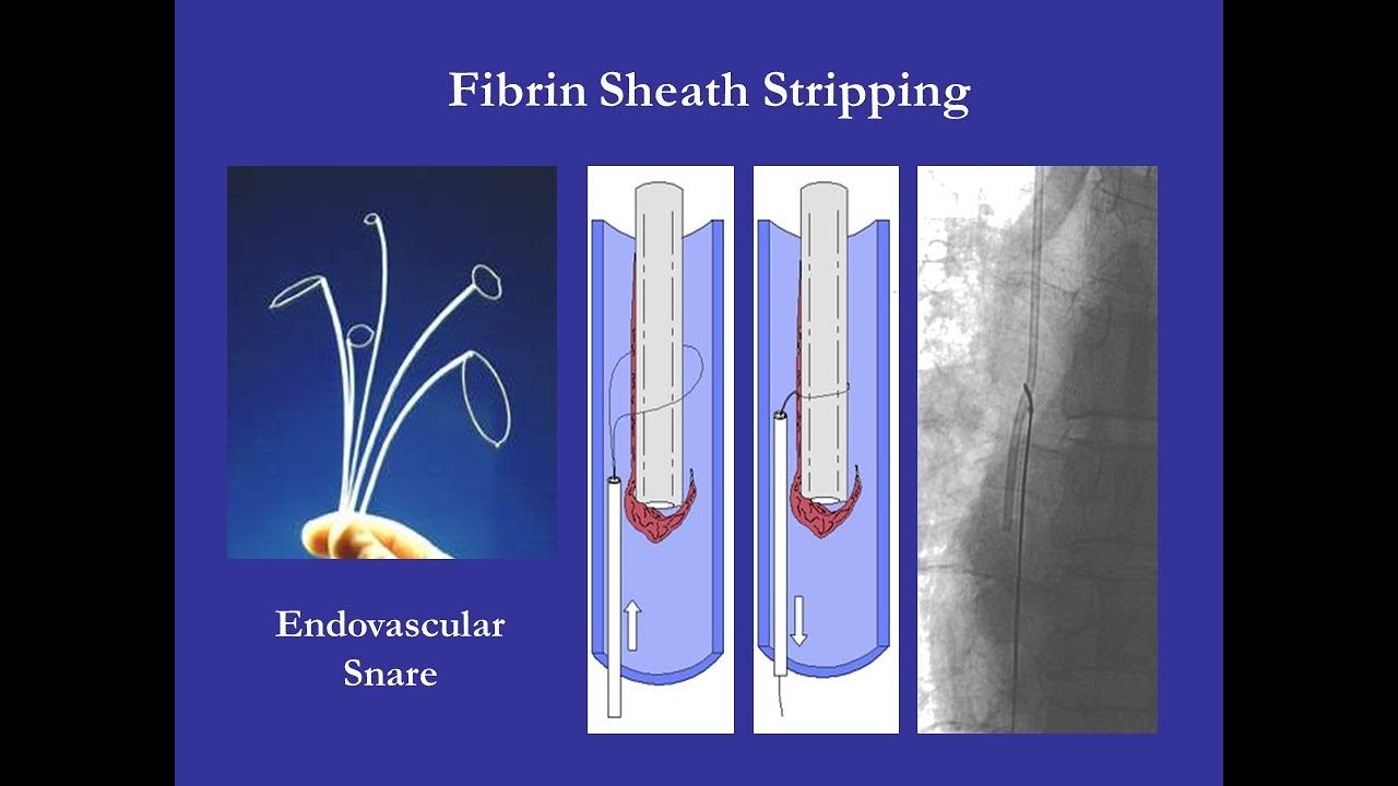 Fibrin Sheath Stripping stripping of fibrin sheath from perm cath tip
