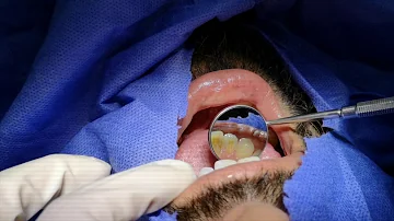 ¿Cómo deshacerse de los dientes amarillos por fumar?