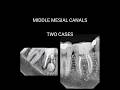 Middle mesial canals#middlemesial#rct #rotary #endo #endodontics #shortvideo