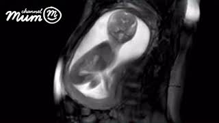 MRI Scan Video of Baby Moving in Womb  Channel Mum