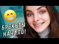 ПОСТАВИЛА БРЕКЕТЫ! Первые ощущения и боль! 😬😱