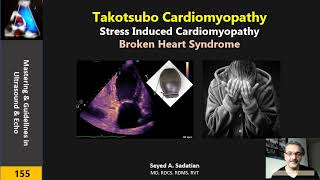 Takotsubo Cardiomyopathy or Broken Heart Syndrome