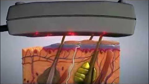 Laser Lipo For Fat Reduction