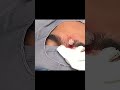 Perfect Cyst Pop Every Time