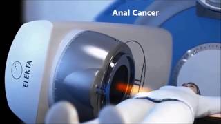External Beam Radiotherapy For Colorectal And Anal Cancer - Korean