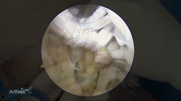 All Arthroscopic Suprapectoral Biceps Tenodesis With Knotless Unicortical Locking Button Technique