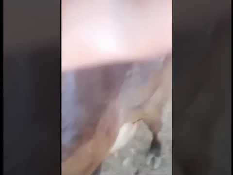 عملية قطع الرباط الانسي للرضفة للدكتور فواز ثتقيفي