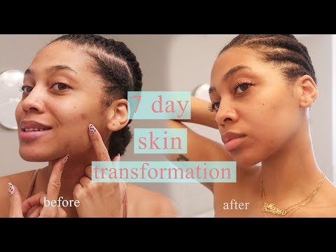  day clear skin transformation | acne and dark mark removal before and after |  J MAYO