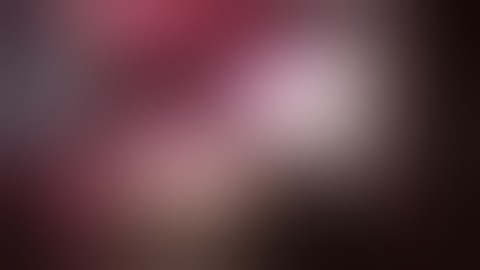 Dr Hitesh Chavda : USG guided multiple metastatectomy for colorectal liver metastases