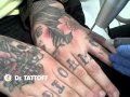 Laser tattoo removal  removing knuckles tattoo  dr tattoff  los angeles  dallas  houston