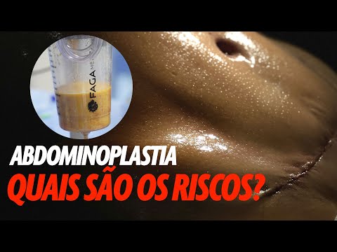 Vídeo: A abdominoplastia é segura?