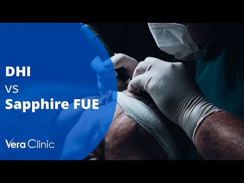 DHI vs. Sapphire FUE: Which Hair Transplant Method Is Right for You?