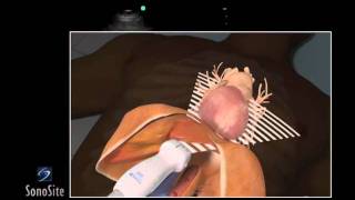 How to: Echocardiography - Subxiphoid View 3D Video