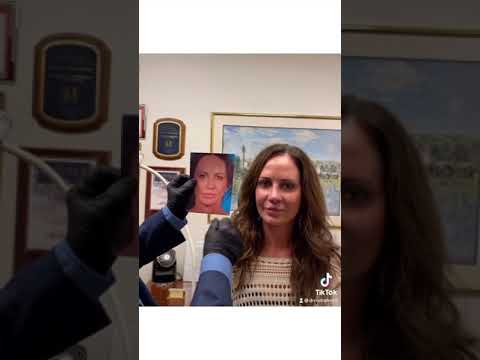 Video thumbnail: Beautiful Revison cleft rhinoplasty/Lip Lift Reveal-Dr. Rod Rohrich — Rod J. Rohrich, M.D. Plastic Surgeon