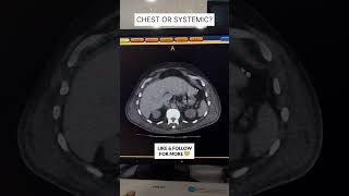 Chronic Kidney Disease CT Findings with Pleural Effusion #shorts