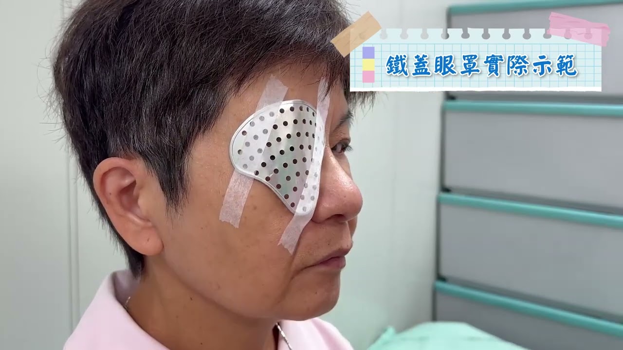 超完整攻略一次看｜白內障術後注意事項 台語版